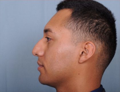 Rhinoplasty Before & After Patient #1124