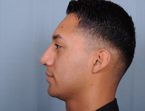 Rhinoplasty Before & After Patient #1124