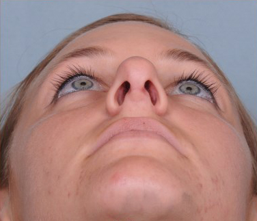 Rhinoplasty Before & After Patient #1123