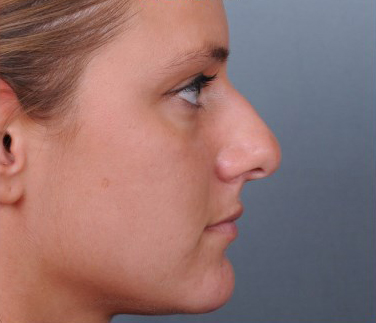 Rhinoplasty Before & After Patient #1123