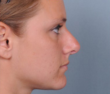 Rhinoplasty Before & After Patient #1123