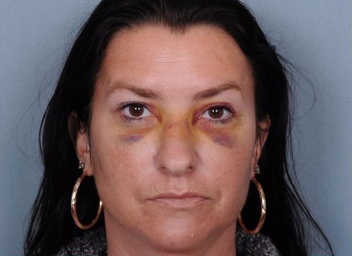 Rhinoplasty Before & After Patient #1122