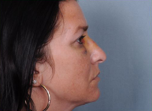 Rhinoplasty Before & After Patient #1122