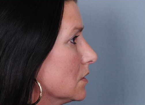 Rhinoplasty Before & After Patient #1122
