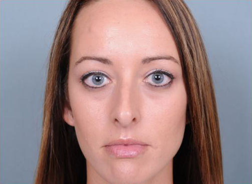 Rhinoplasty Before & After Patient #1103