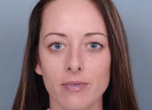 Rhinoplasty Before & After Patient #1103