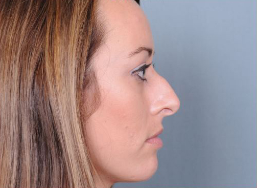 Rhinoplasty Before & After Patient #1103