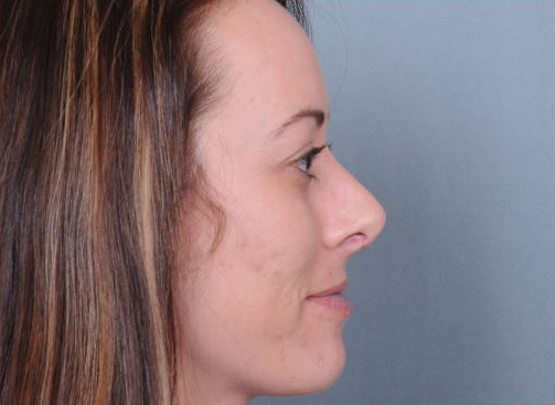 Rhinoplasty Before & After Patient #1103