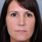 Rhinoplasty Before & After Patient #1175