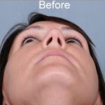 Rhinoplasty Before & After Patient #1175