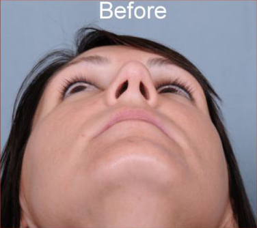 Rhinoplasty Before & After Patient #1175