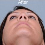 Rhinoplasty Before & After Patient #1175