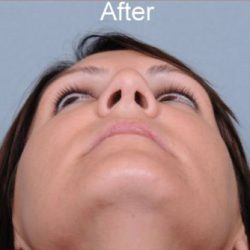 Rhinoplasty Before & After Patient #1175