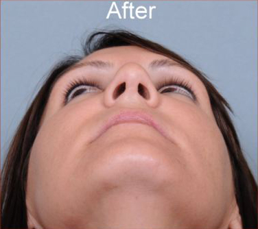 Rhinoplasty Before & After Patient #1175