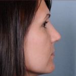 Rhinoplasty Before & After Patient #1175