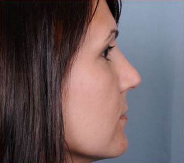 Rhinoplasty Before & After Patient #1175