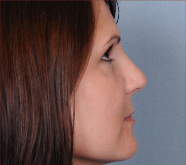 Rhinoplasty Before & After Patient #1175