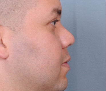 Rhinoplasty Before & After Patient #1194