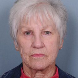 Facelift Before & After Patient #553