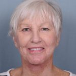 Facelift Before & After Patient #553