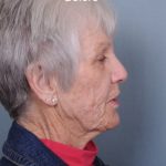 Facelift Before & After Patient #553