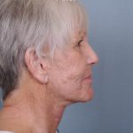 Facelift Before & After Patient #553