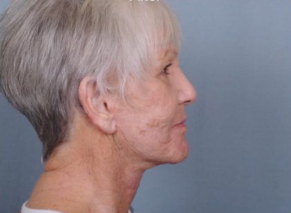 Facelift Before & After Patient #553