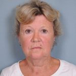 Facelift Before & After Patient #561