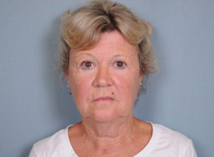 Facelift Before & After Patient #561