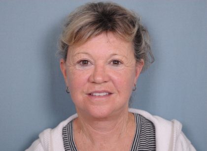 Facelift Before & After Patient #561