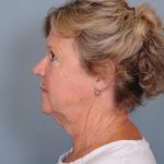 Facelift Before & After Patient #561
