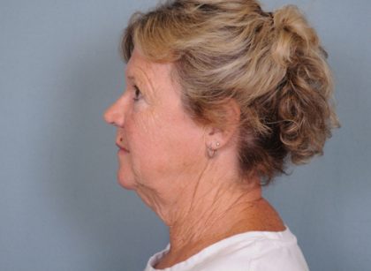 Facelift Before & After Patient #561