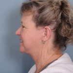Facelift Before & After Patient #561