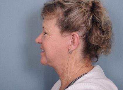 Facelift Before & After Patient #561