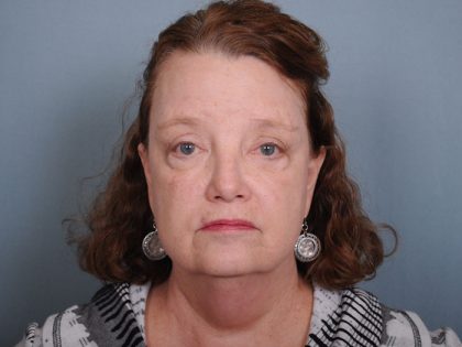 Blepharoplasty Before & After Patient #550