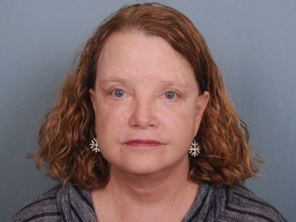 Blepharoplasty Before & After Patient #550
