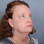 Blepharoplasty Before & After Patient #550