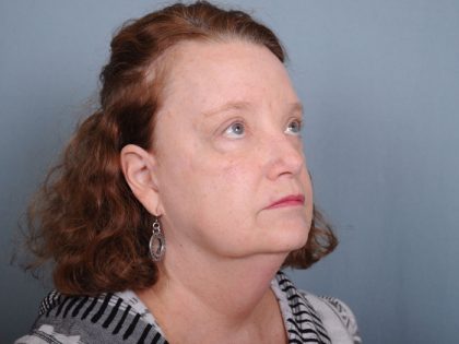 Blepharoplasty Before & After Patient #550