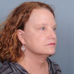 Blepharoplasty Before & After Patient #550