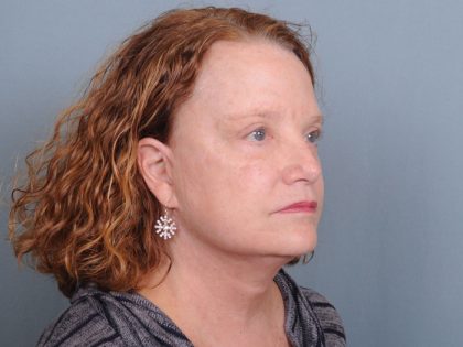 Blepharoplasty Before & After Patient #550