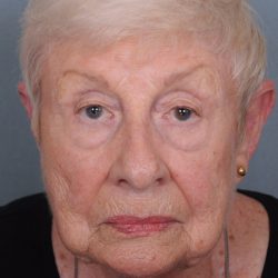 Blepharoplasty Before & After Patient #549