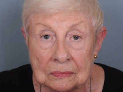 Blepharoplasty Before & After Patient #549