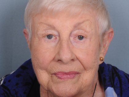 Blepharoplasty Before & After Patient #549