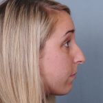 Rhinoplasty Before & After Patient #548