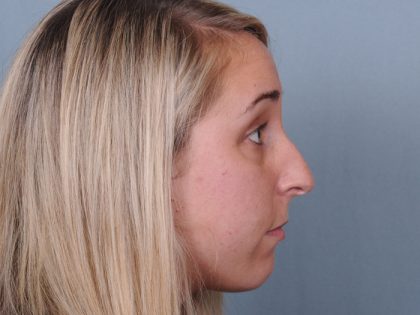 Rhinoplasty Before & After Patient #548