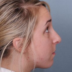 Rhinoplasty Before & After Patient #548