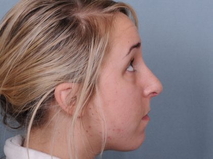 Rhinoplasty Before & After Patient #548