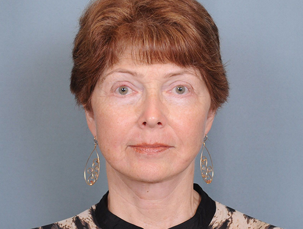 Blepharoplasty Before & After Patient #551