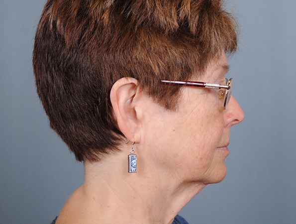 Facelift Before & After Patient #4509