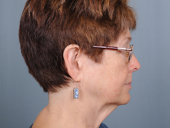 Blepharoplasty Before & After Patient #551
